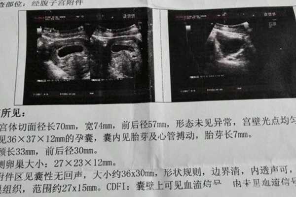 郑州人工受精医院哪家上海中山医院有供卵试管吗好-甲胎蛋白是检查什么的-最