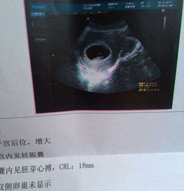 深圳哪里有借卵生子医院_试管移植39天是正常怀孕多少天，从孕囊大小怎么算孕