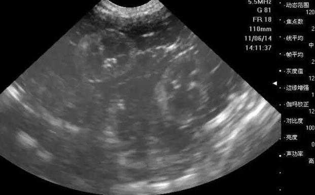 甘肃卵巢性不孕治疗专家,2023甘肃妇产医院取卵手术前预付的押金怎么退？